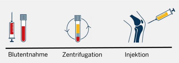 Anwendung PRP-1